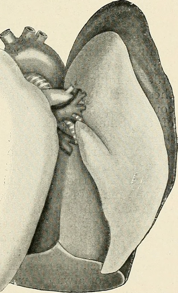 An illustration from Surgery of the lung, 1913, leaf 144