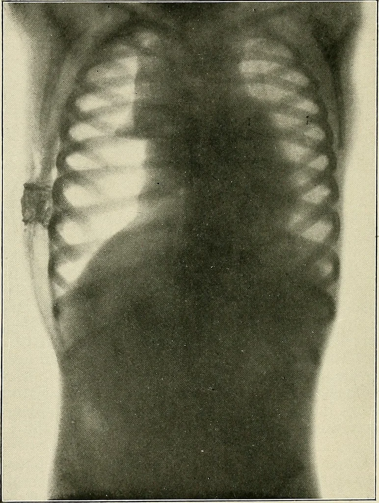 An illustration from Surgery of the lung, 1913, leaf 153