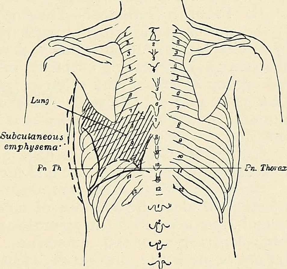 An illustration from Surgery of the lung, 1913, leaf 160
