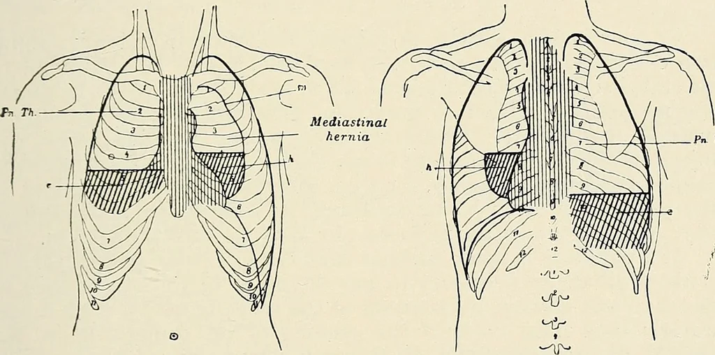 An illustration from Surgery of the lung, 1913, leaf 162