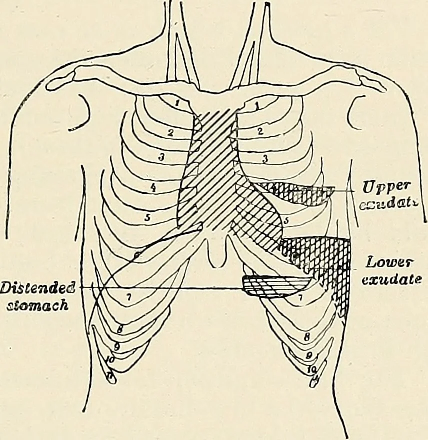 An illustration from Surgery of the lung, 1913, leaf 164