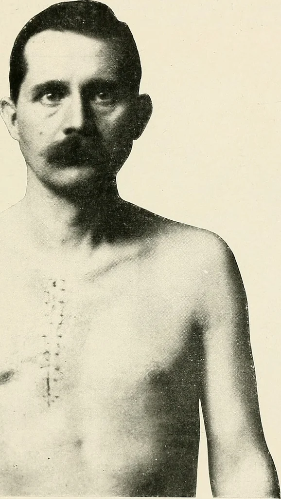 An illustration from Surgery of the lung, 1913, leaf 184