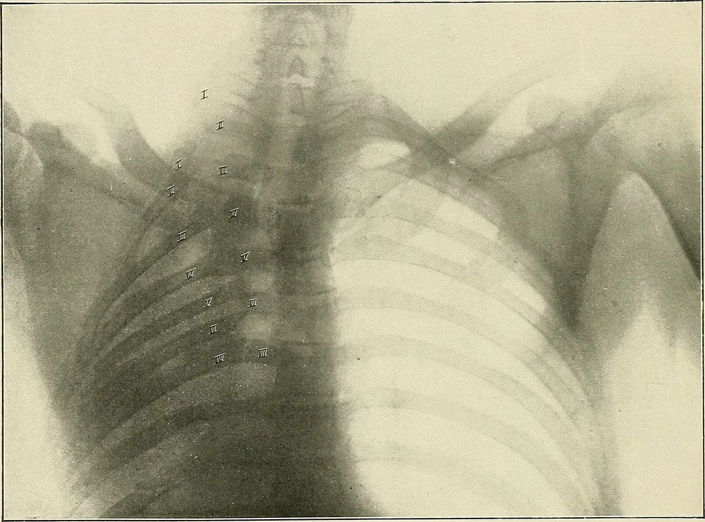 An illustration from Surgery of the lung, 1913, leaf 185