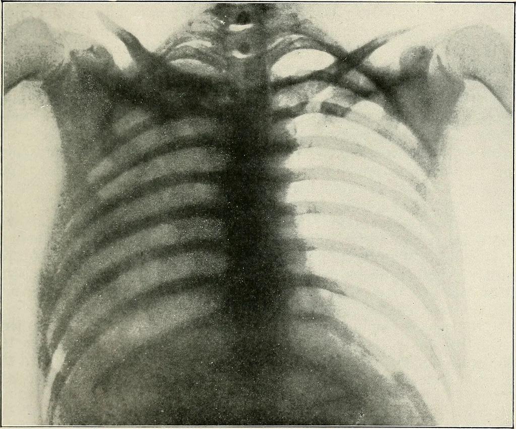 An illustration from Surgery of the lung, 1913, leaf 198