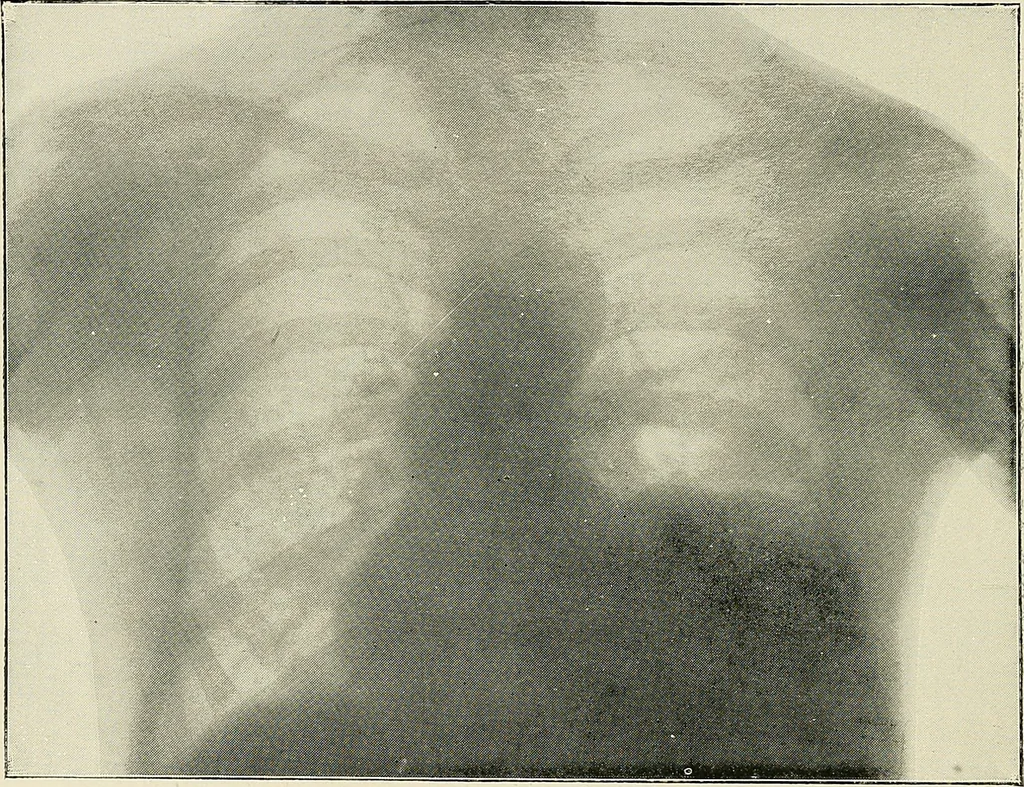 An illustration from Surgery of the lung, 1913, leaf 215