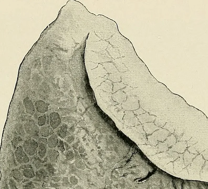 An illustration from Surgery of the lung, 1913, leaf 217