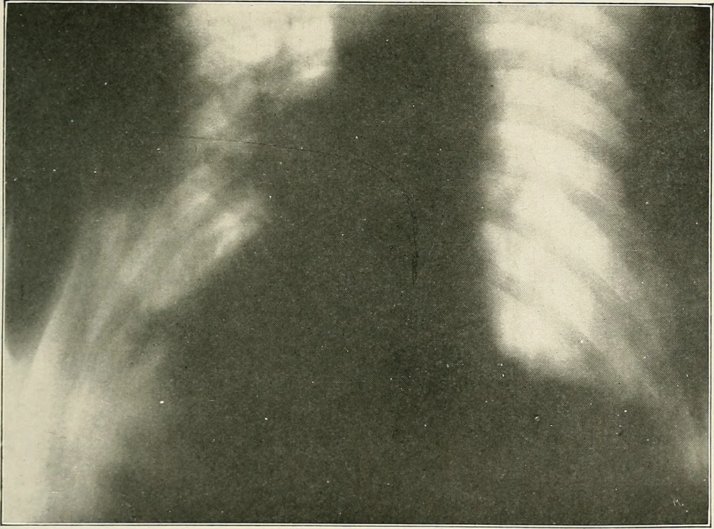An illustration from Surgery of the lung, 1913, leaf 220