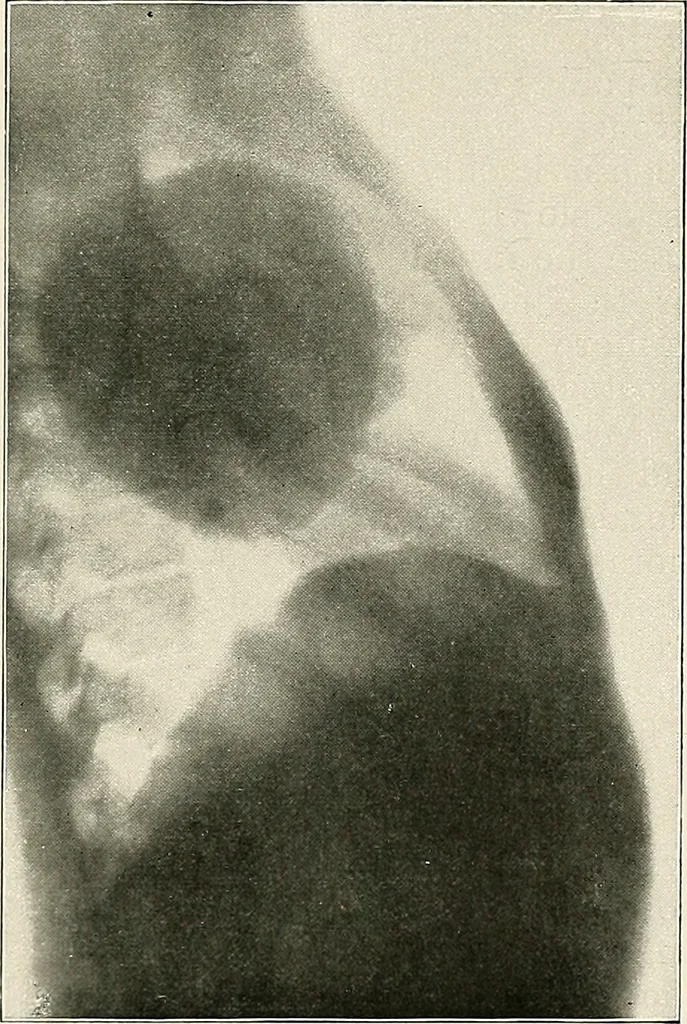 An illustration from Surgery of the lung, 1913, leaf 228
