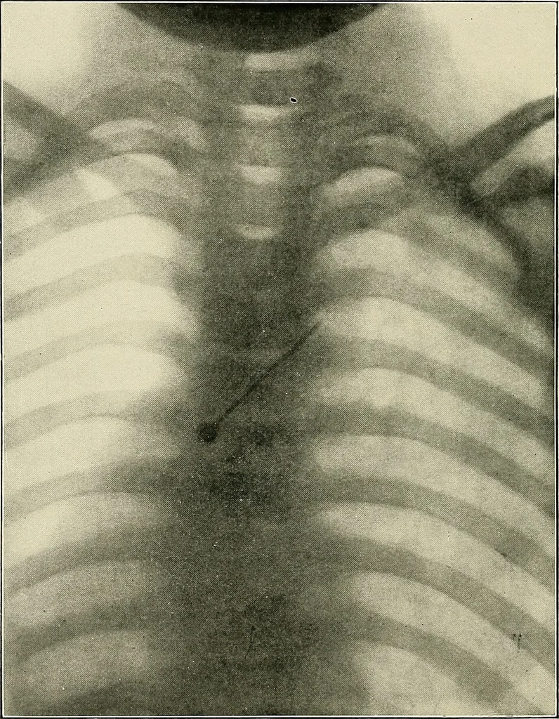 An illustration from Surgery of the lung, 1913, leaf 235