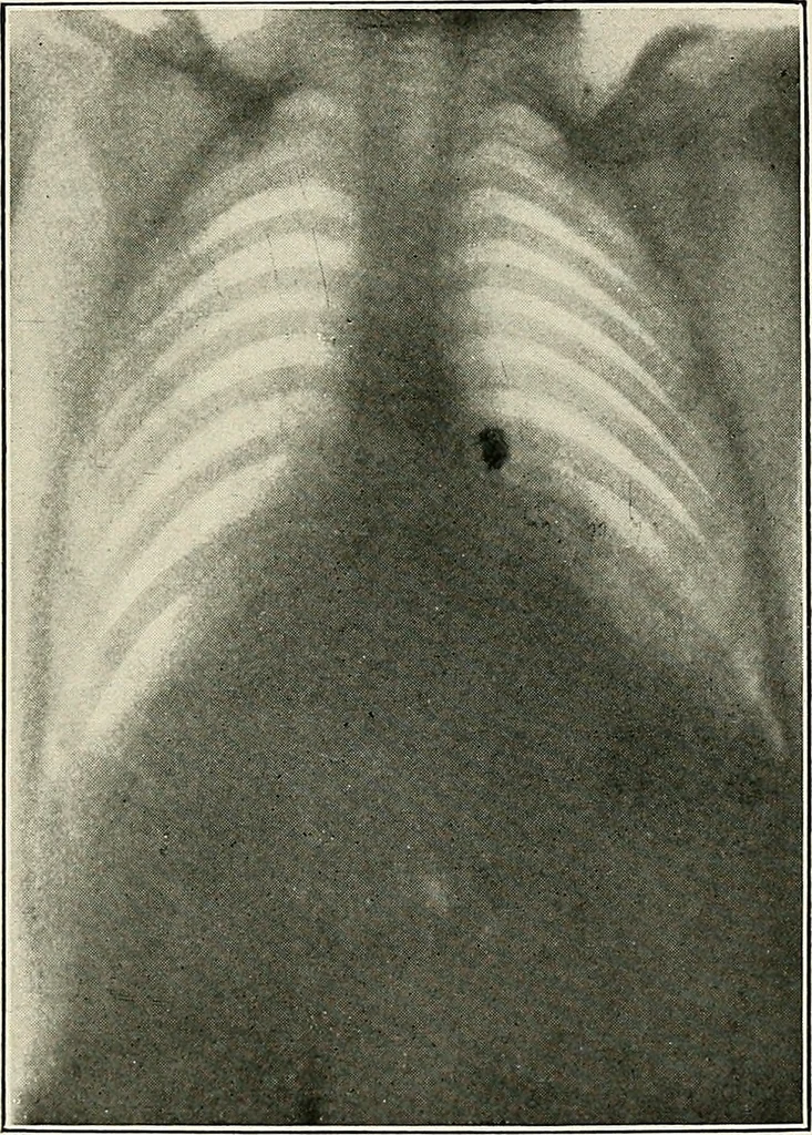 An illustration from Surgery of the lung, 1913, leaf 236