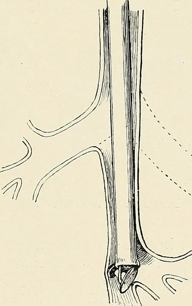 An illustration from Surgery of the lung, 1913, leaf 242