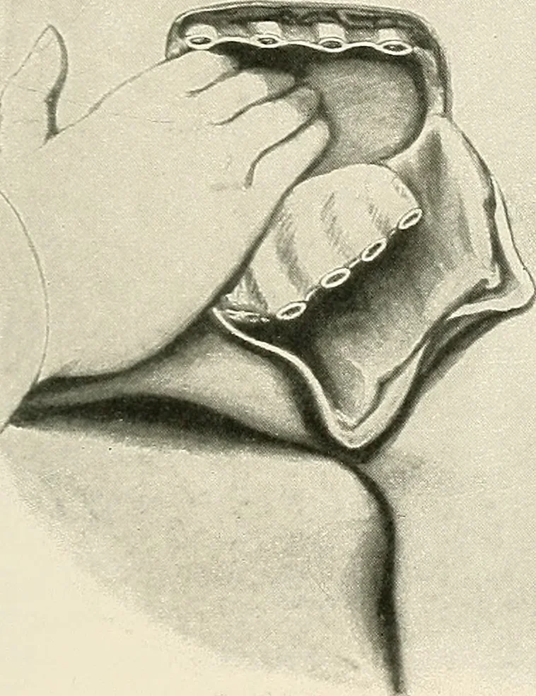 An illustration from Surgery of the lung, 1913, leaf 244