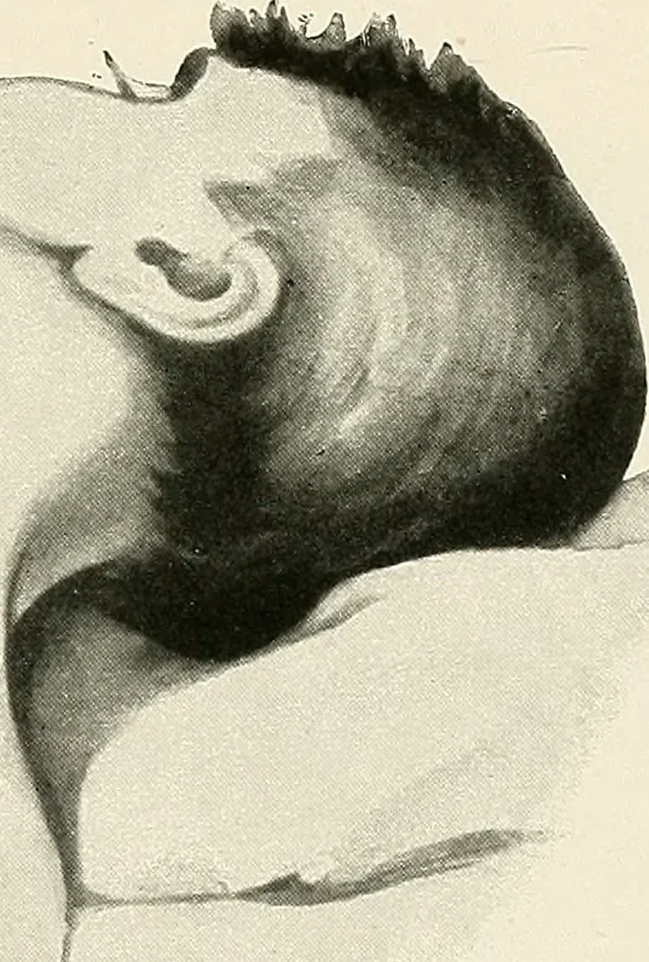 An illustration from Surgery of the lung, 1913, leaf 244