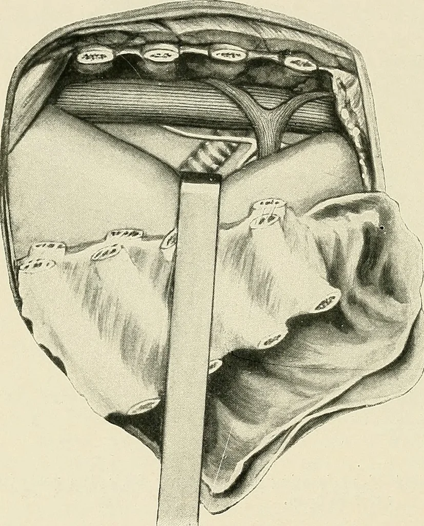 An illustration from Surgery of the lung, 1913, leaf 245