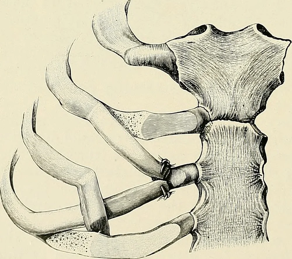 An illustration from Surgery of the lung, 1913, leaf 251