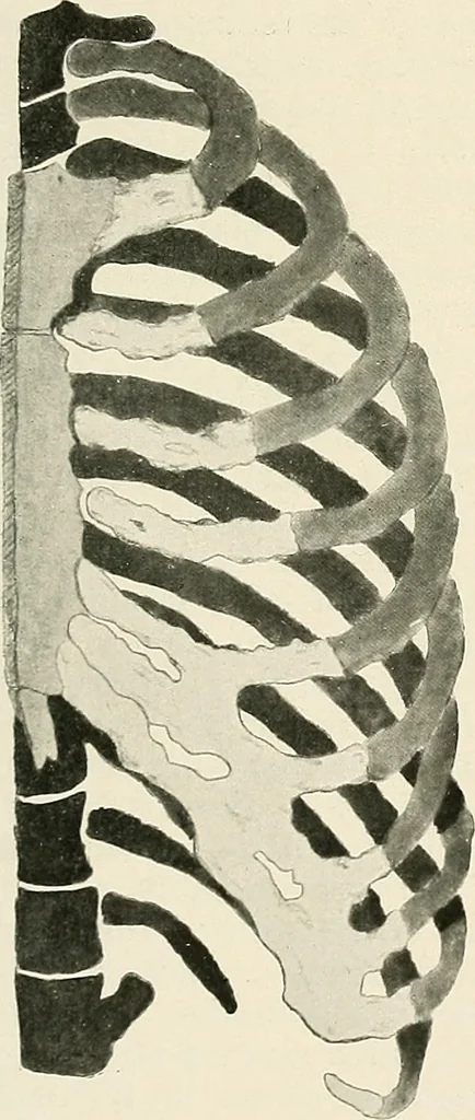 An illustration from Surgery of the lung, 1913, leaf 260