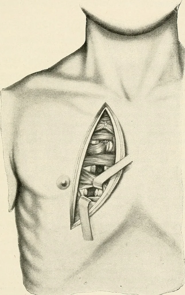 An illustration from Surgery of the lung, 1913, leaf 268