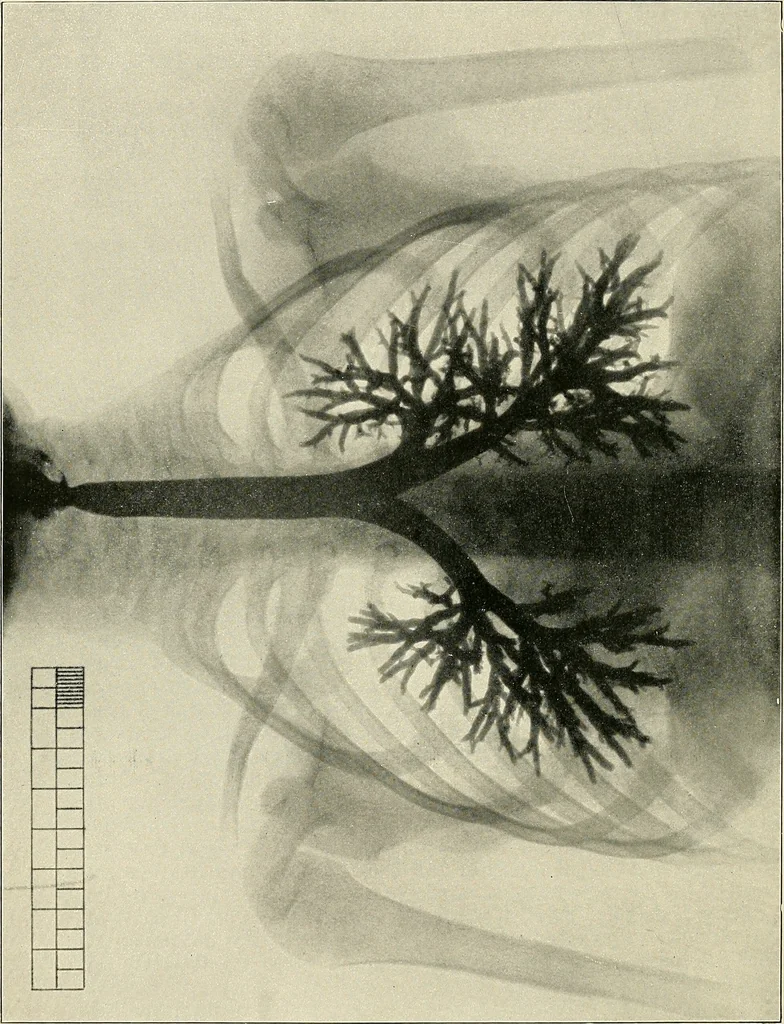 An illustration from Surgery of the lung, 1913, leaf 35