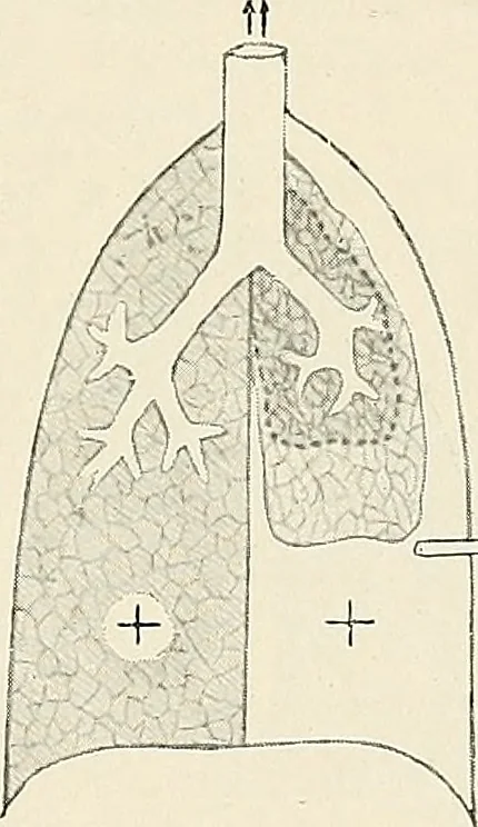 An illustration from Surgery of the lung, 1913, leaf 38