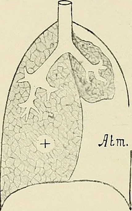 An illustration from Surgery of the lung, 1913, leaf 39