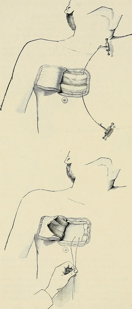 An illustration from Surgery of the lung, 1913, leaf 77
