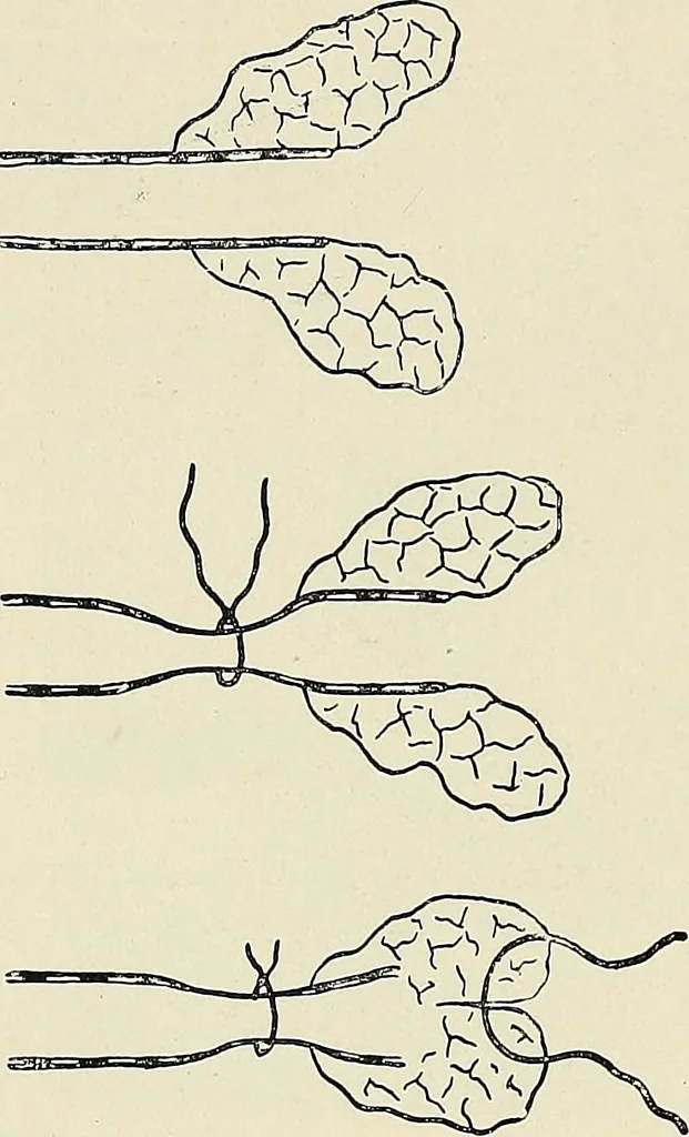 An illustration from Surgery of the lung, 1913, leaf 81