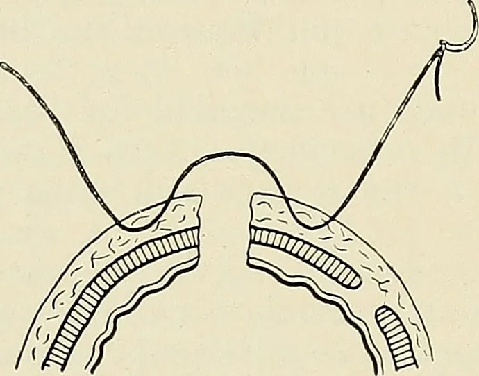 An illustration from Surgery of the lung, 1913, leaf 97