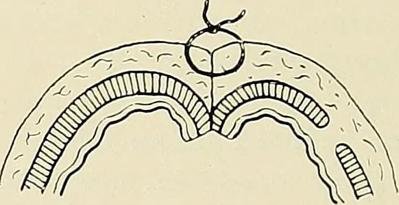 An illustration from Surgery of the lung, 1913, leaf 97