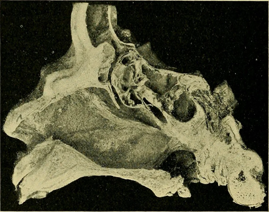An illustration from A text-book of diseases of the nose and throat, 1904, leaf 129
