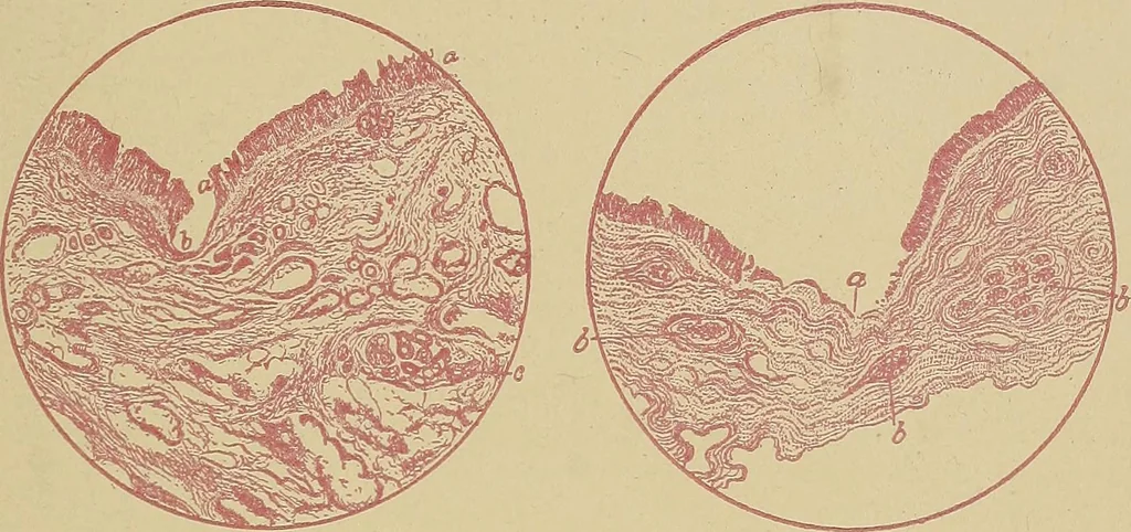 An illustration from A text-book of diseases of the nose and throat, 1904, leaf 132
