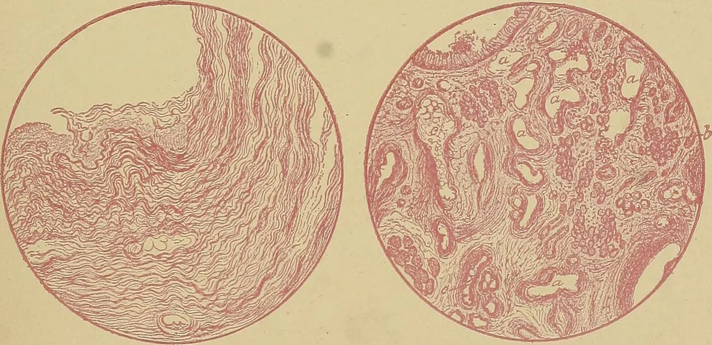 An illustration from A text-book of diseases of the nose and throat, 1904, leaf 132