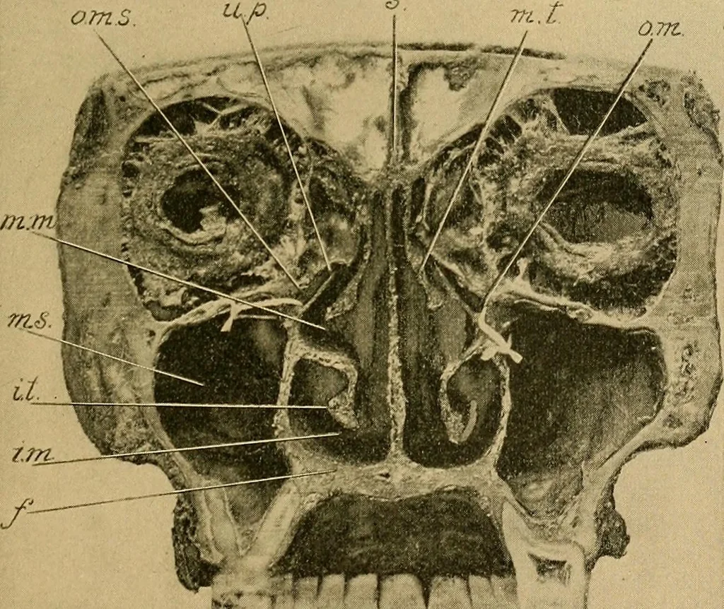 An illustration from A text-book of diseases of the nose and throat, 1904, leaf 24