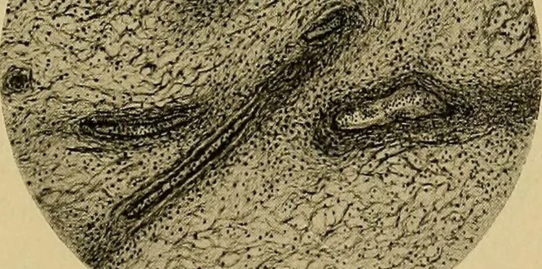 An illustration from A text-book of diseases of the nose and throat, 1904, leaf 244