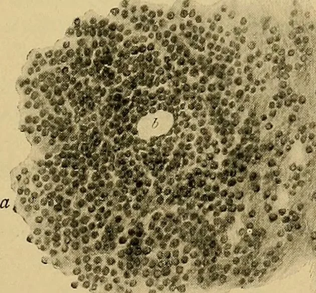 An illustration from A text-book of diseases of the nose and throat, 1904, leaf 248