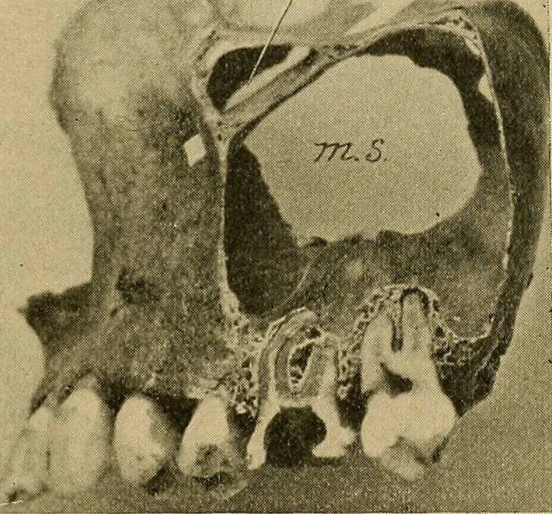 An illustration from A text-book of diseases of the nose and throat, 1904, leaf 28