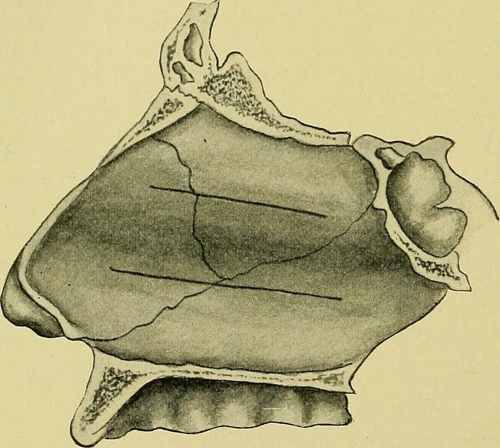 An illustration from A text-book of diseases of the nose and throat, 1904, leaf 283