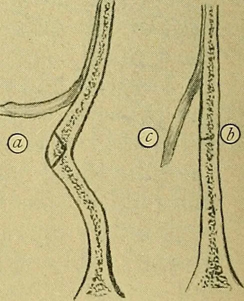 An illustration from A text-book of diseases of the nose and throat, 1904, leaf 285