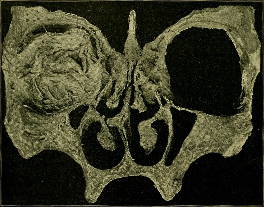 An illustration from A text-book of diseases of the nose and throat, 1904, leaf 289