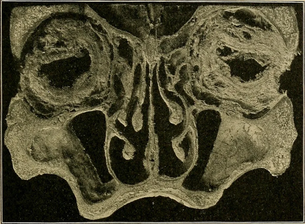 An illustration from A text-book of diseases of the nose and throat, 1904, leaf 308