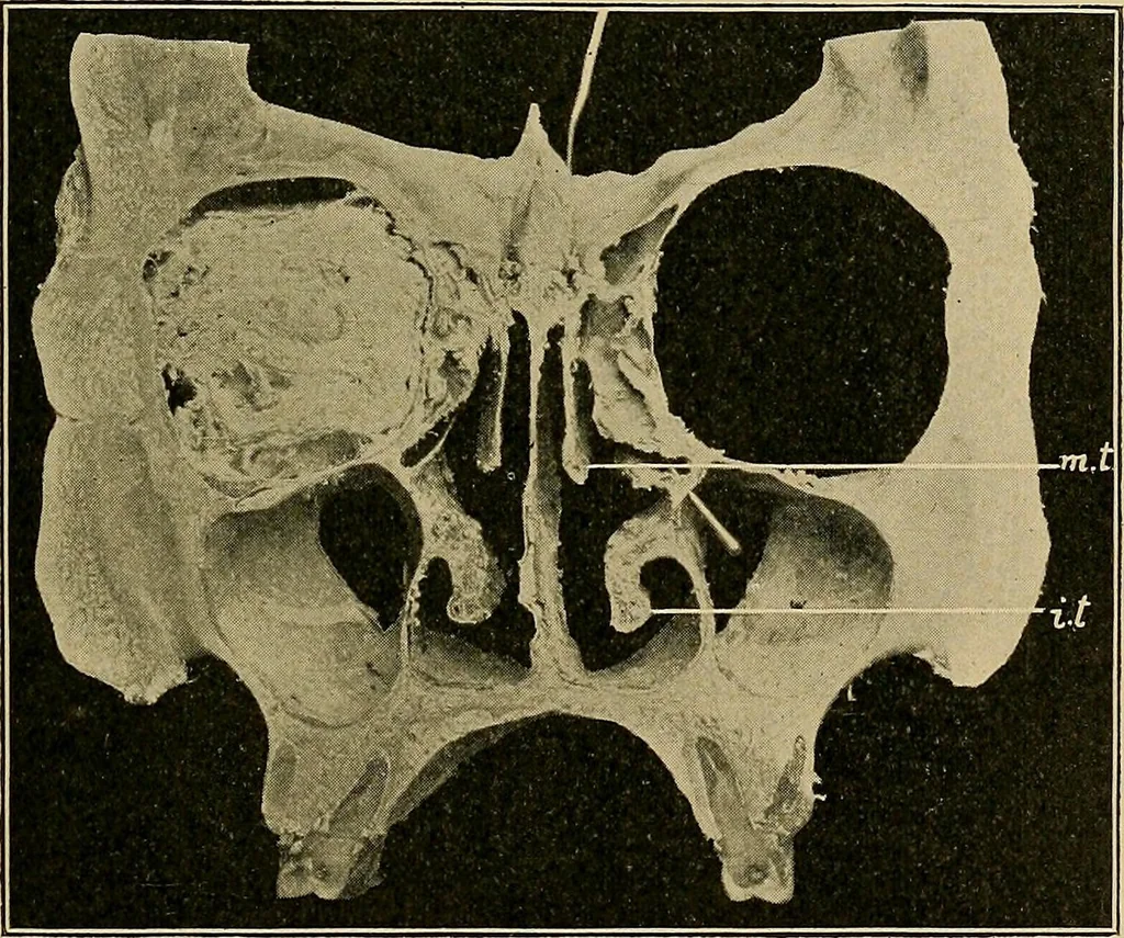 An illustration from A text-book of diseases of the nose and throat, 1904, leaf 312