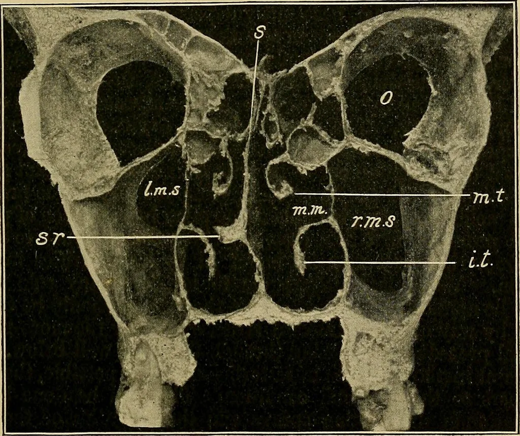 An illustration from A text-book of diseases of the nose and throat, 1904, leaf 318