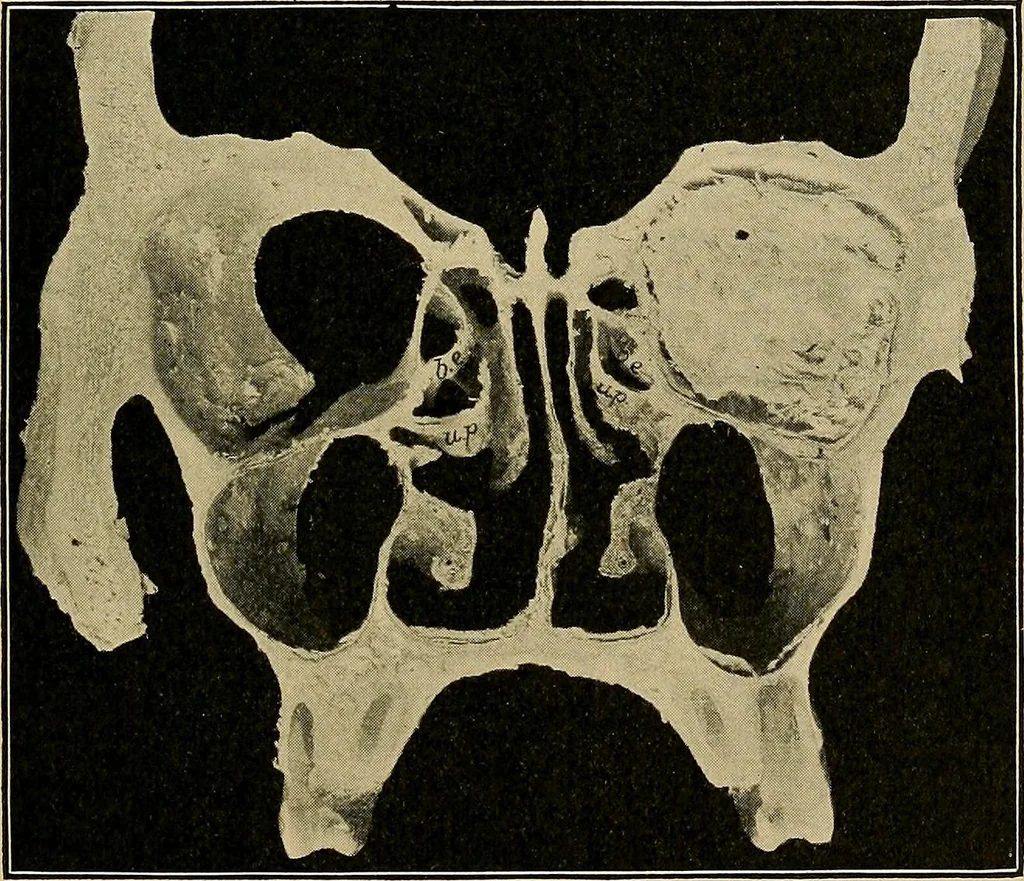 An illustration from A text-book of diseases of the nose and throat, 1904, leaf 320