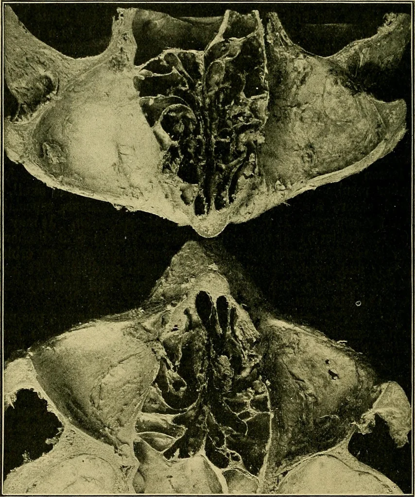 An illustration from A text-book of diseases of the nose and throat, 1904, leaf 329
