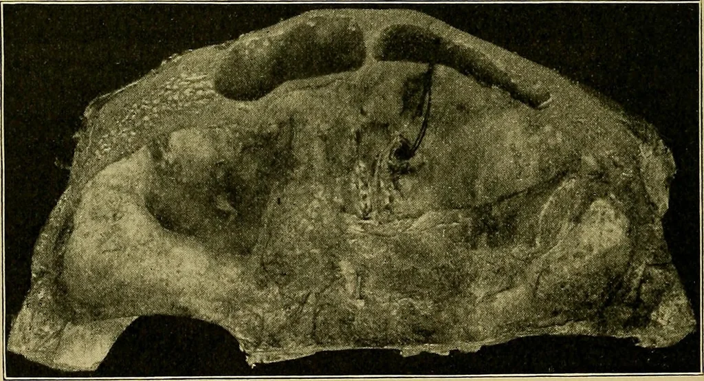An illustration from A text-book of diseases of the nose and throat, 1904, leaf 345