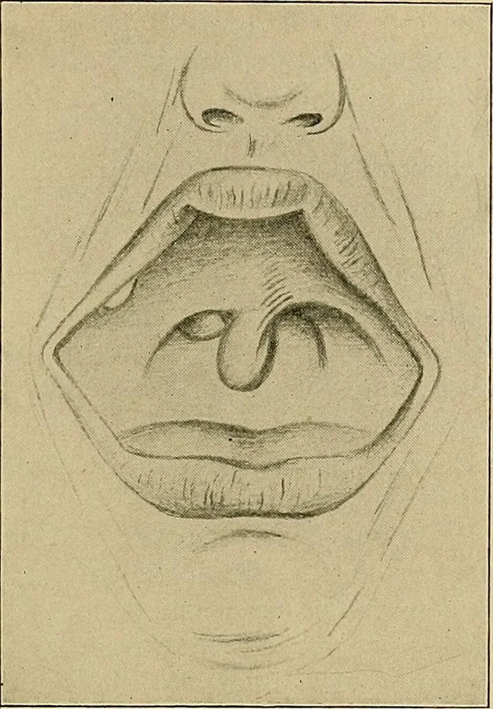 An illustration from A text-book of diseases of the nose and throat, 1904, leaf 374