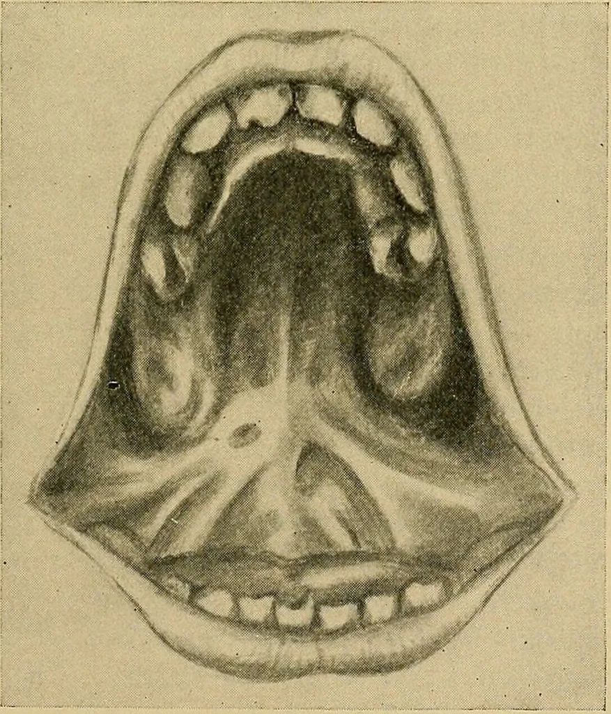 An illustration from A text-book of diseases of the nose and throat, 1904, leaf 374