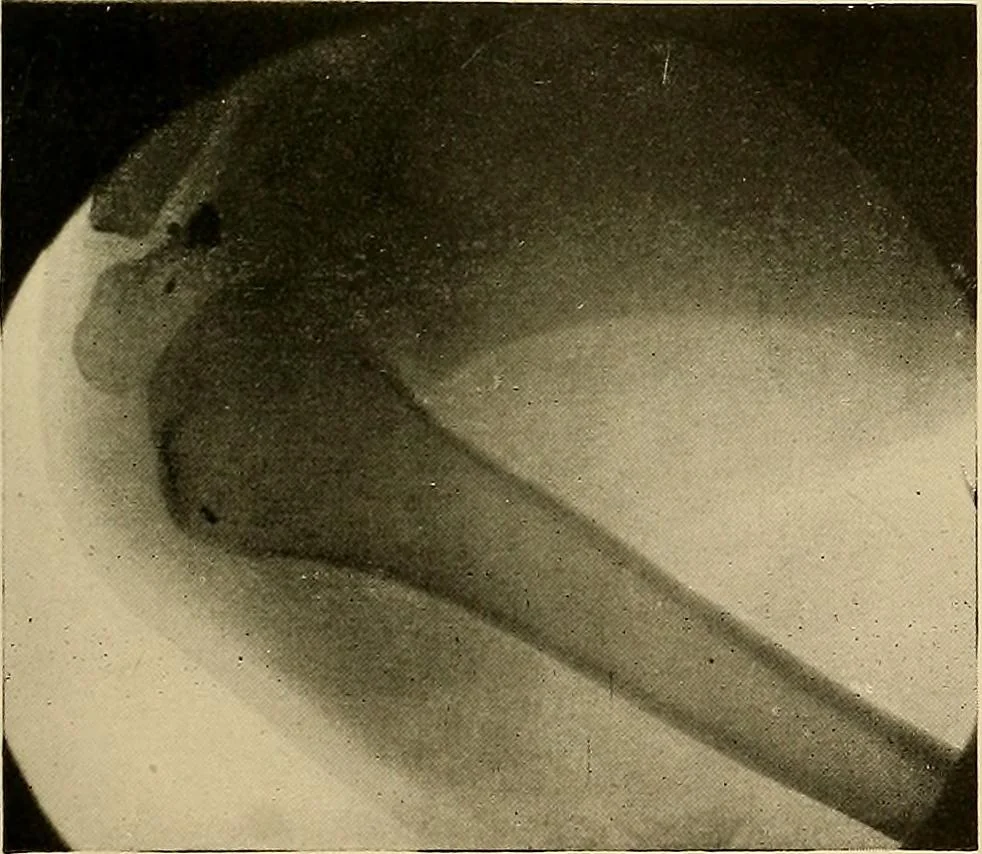 An illustration from A text-book of radiology, 1915, leaf 154