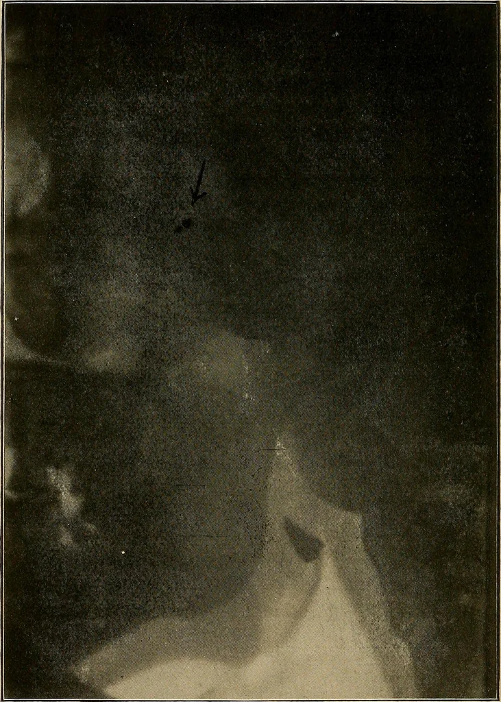 An illustration from A text-book of radiology, 1915, leaf 165