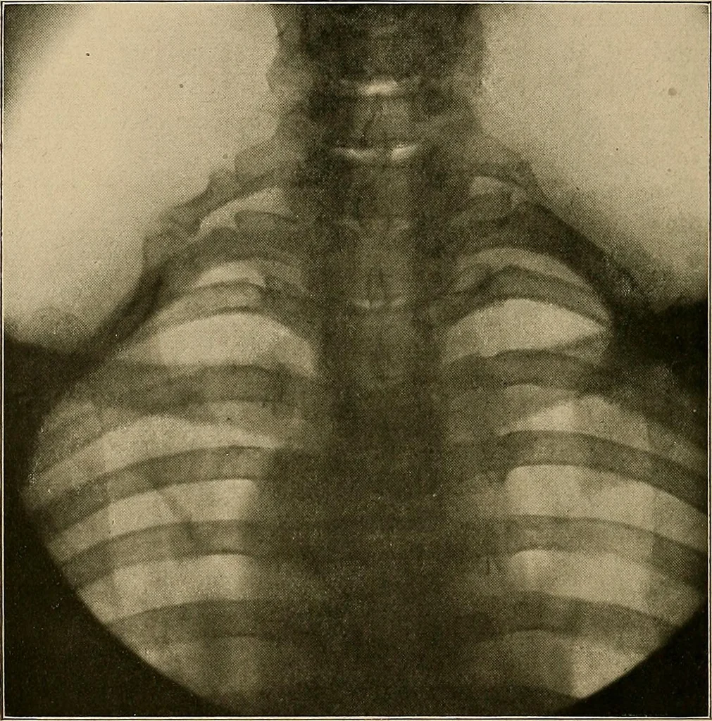 An illustration from A text-book of radiology, 1915, leaf 167