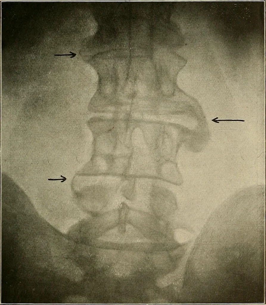 An illustration from A text-book of radiology, 1915, leaf 168
